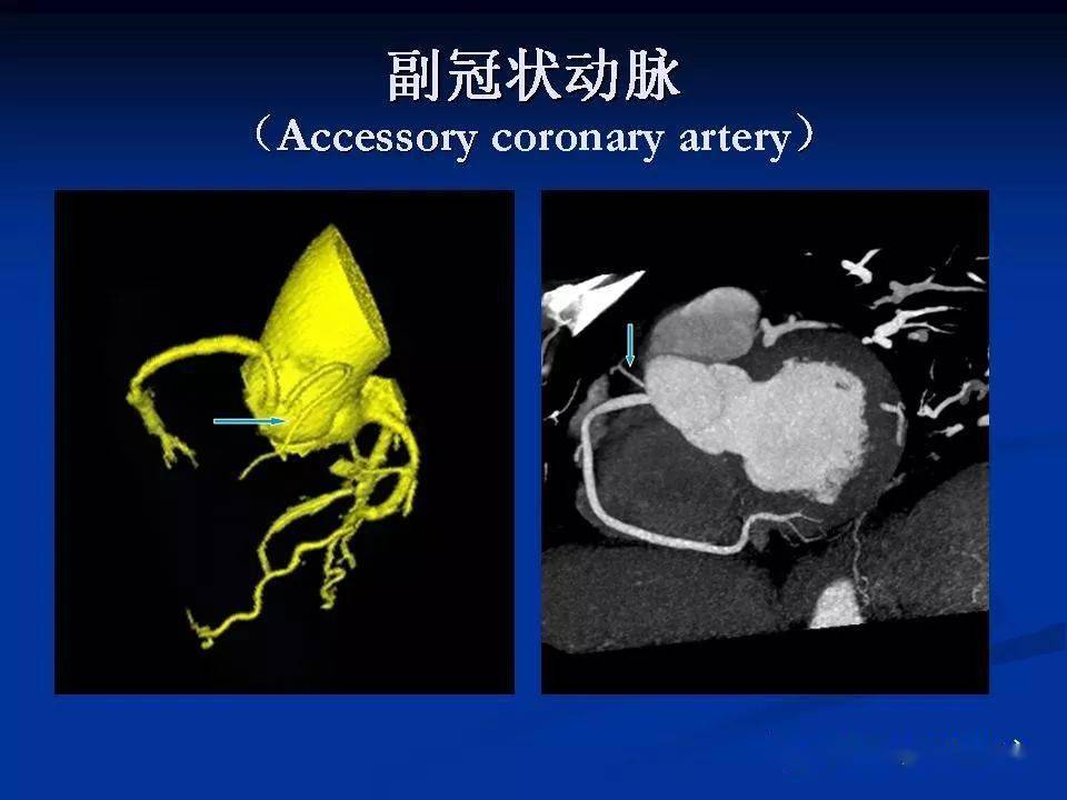 详细解读冠状动脉及冠心病ct