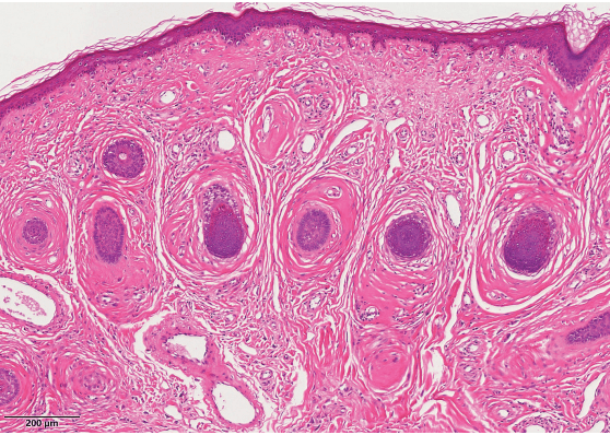 毛囊周围纤维瘤:真皮内毛囊增多,周围纤维组织增生