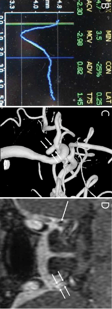 
Neurology：规避瞳孔的后交通动脉瘤“开云手机在线登陆入口”(图2)