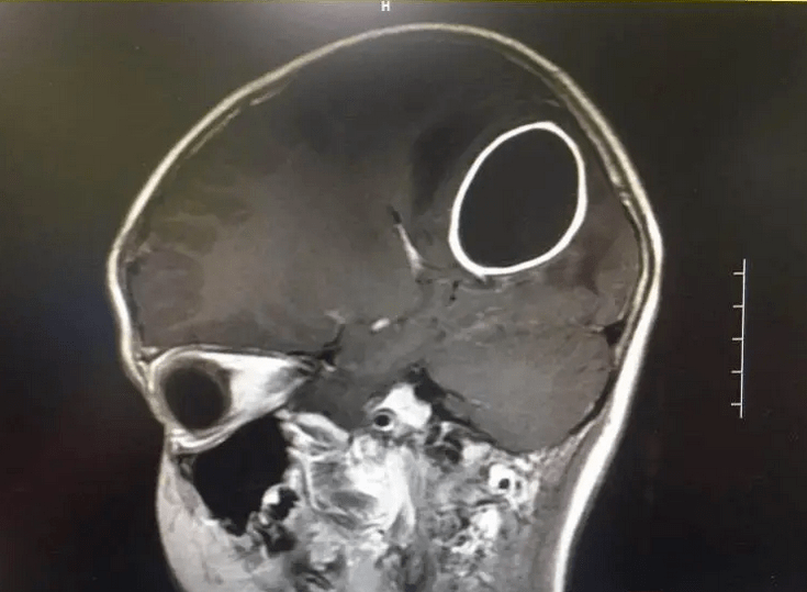 晓晓|竟是因为蛀牙！九成家长都会遇到的问题......8岁女童脑部长巨大脓肿要开颅