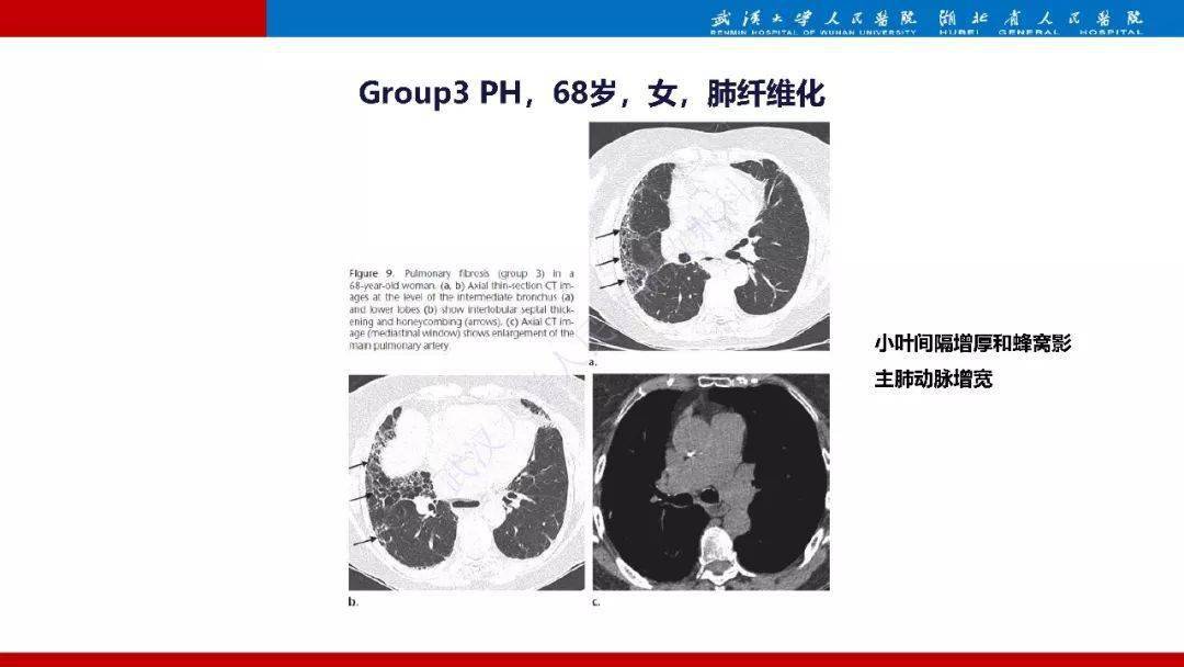 肺动脉高压临床分类及ct表现