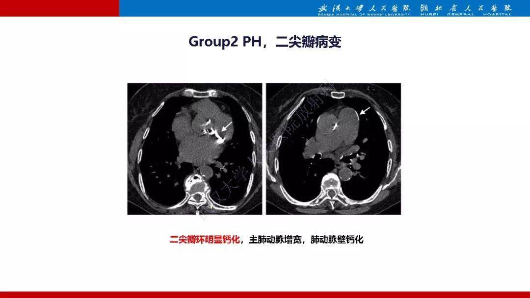 肺动脉高压临床分类及ct表现