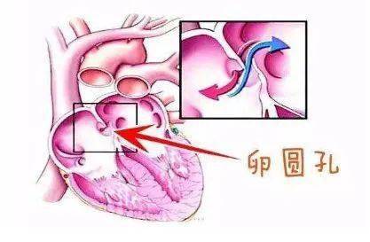 病因|反复脑梗，十年头疼，都是因为多长了一个“心眼”