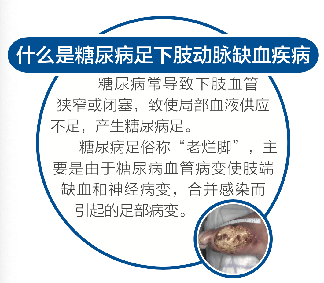 广安门|【广医时讯】广安门医院举办“周围血管疾病义诊宣传日”系列活动