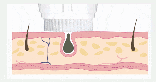 清洁|电动牙刷真的比普通牙刷好吗？我替你们问了医生