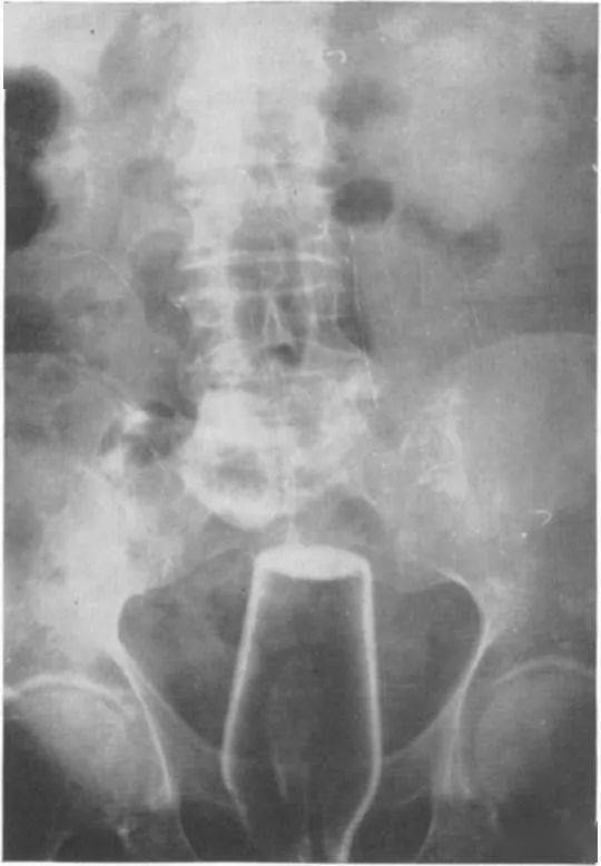 塞2斤金条藏8部手机…人类对肛门的探索太可怕了