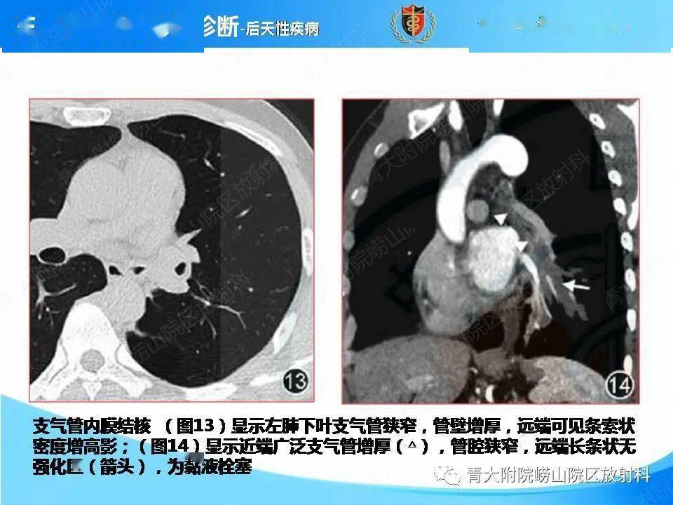 支气管黏液栓塞的影像诊断与鉴别