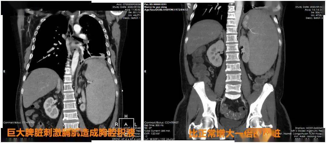 帮扶|【帮扶故事】技术帮扶获突破，深圳市中医院助力龙川县中医院完成首例腹腔镜巨脾切除术