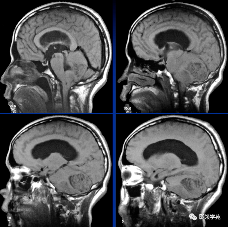 小脑发育不良性神经节细胞瘤的mri诊断