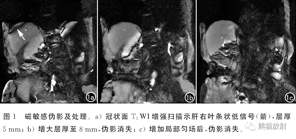 mri体部常见伪影及对策