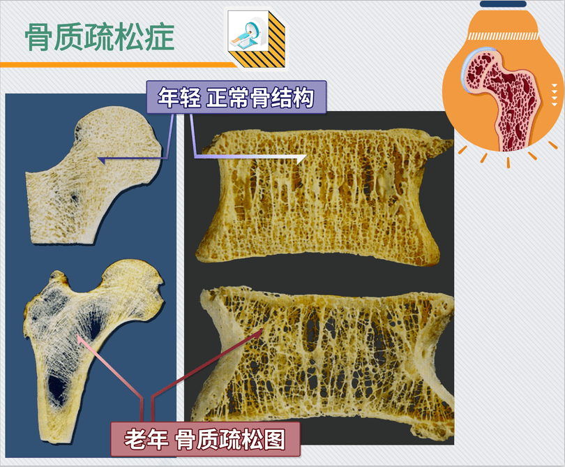 运动|90后开始养生，不如从预防骨质疏松开始，做好这3点最关键！