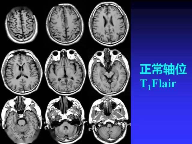 mr入门 | 头颅mri读片知识,需掌握!