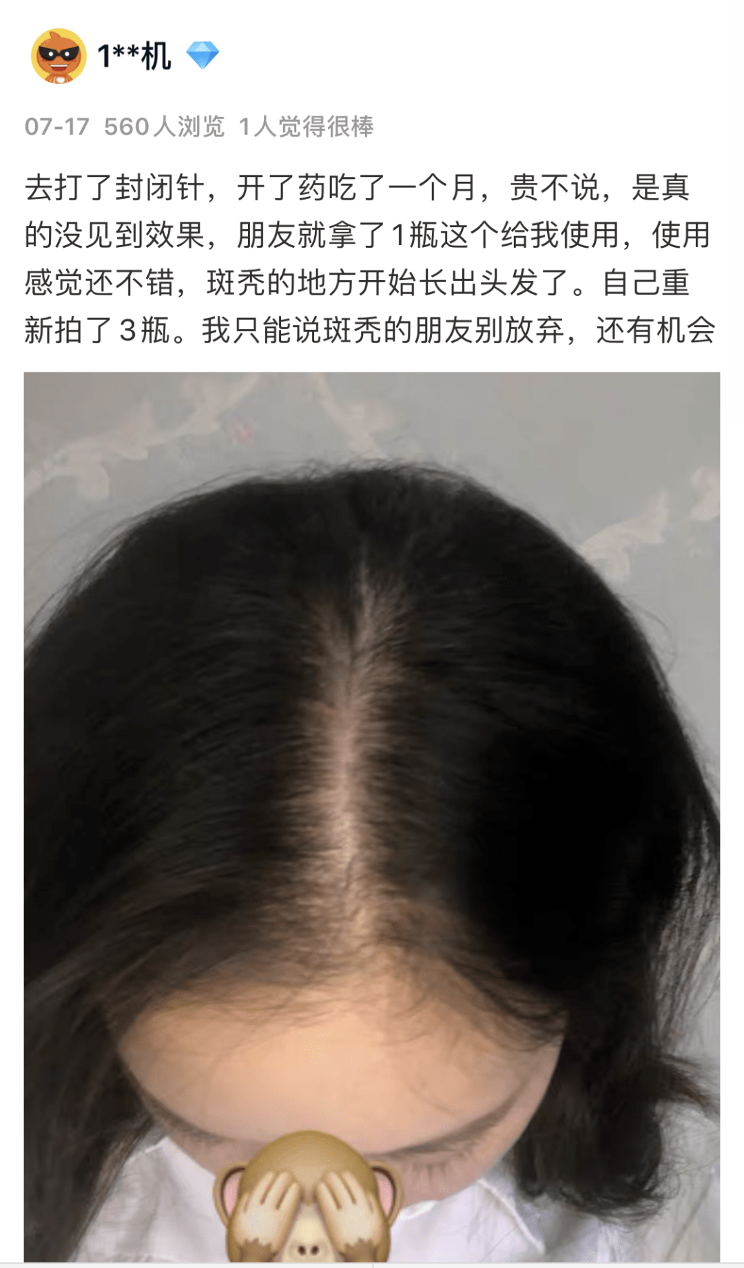 毛囊|流女星们的“狮子头”都是假象？录节目竟然当场掉下假发片，真相竟然是……