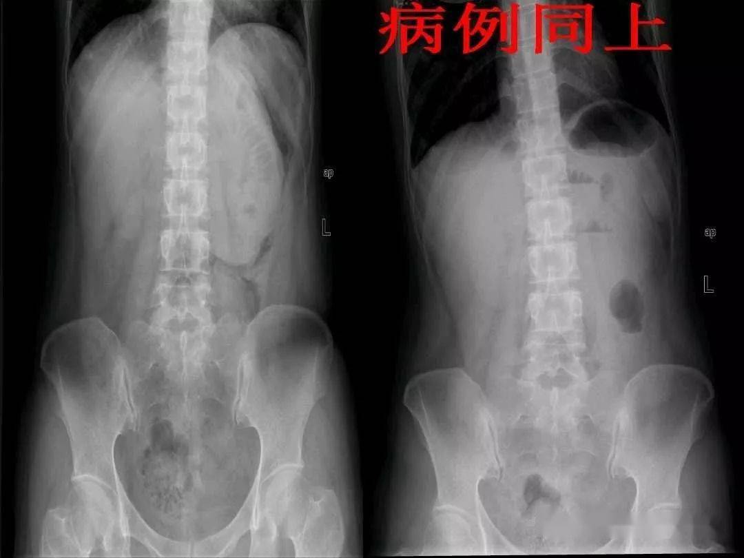 ct上如何寻找肠梗阻的梗阻点