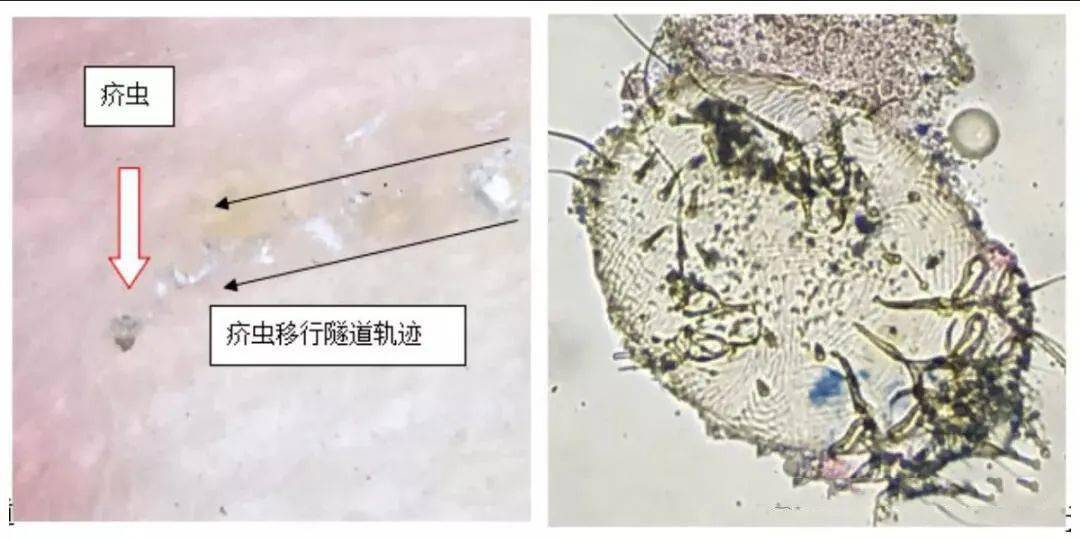 常伴有夜间阵发性剧烈瘙痒,皮损主要为红色丘疹,丘疱疹,小水疱,隧道