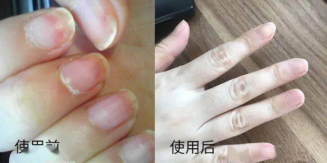 灰指甲为何难以恢复?这些误区现在知道还不晚