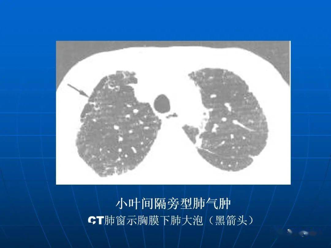 肺气肿的影像诊断