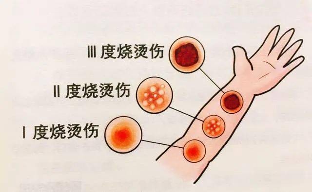 【二院医生说】烧伤分度是怎么一回事?