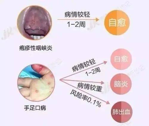 【家园共育】一种特殊的感冒——疱疹性咽峡炎