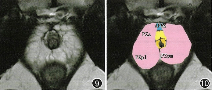 前列腺丨mri解剖分区
