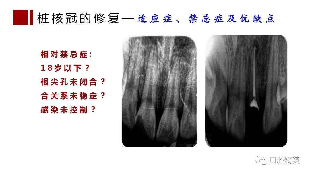 根管治疗桩核选择和桩冠修复