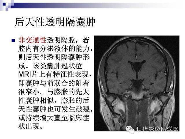 透明隔间腔的影像学及临床意义