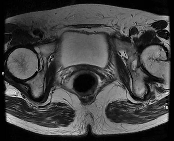 医学笔记|一起读盆腔核磁共振:经女性股骨头韧带的横断层
