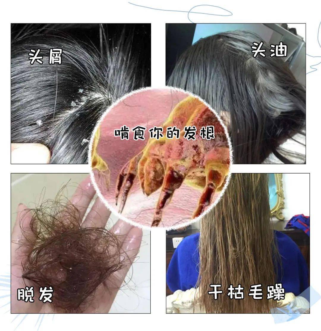 克兰|头上抠下的“白泥”，居然不是头皮屑？脱发头油都是因为它？