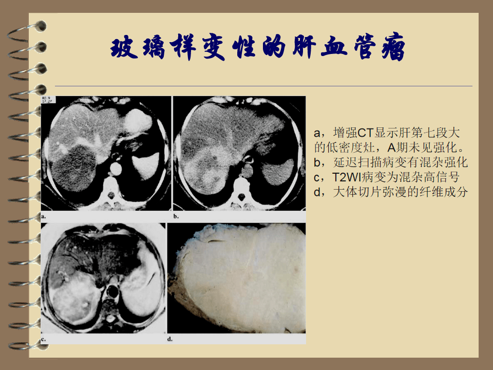 不典型肝脏血管瘤影像诊断