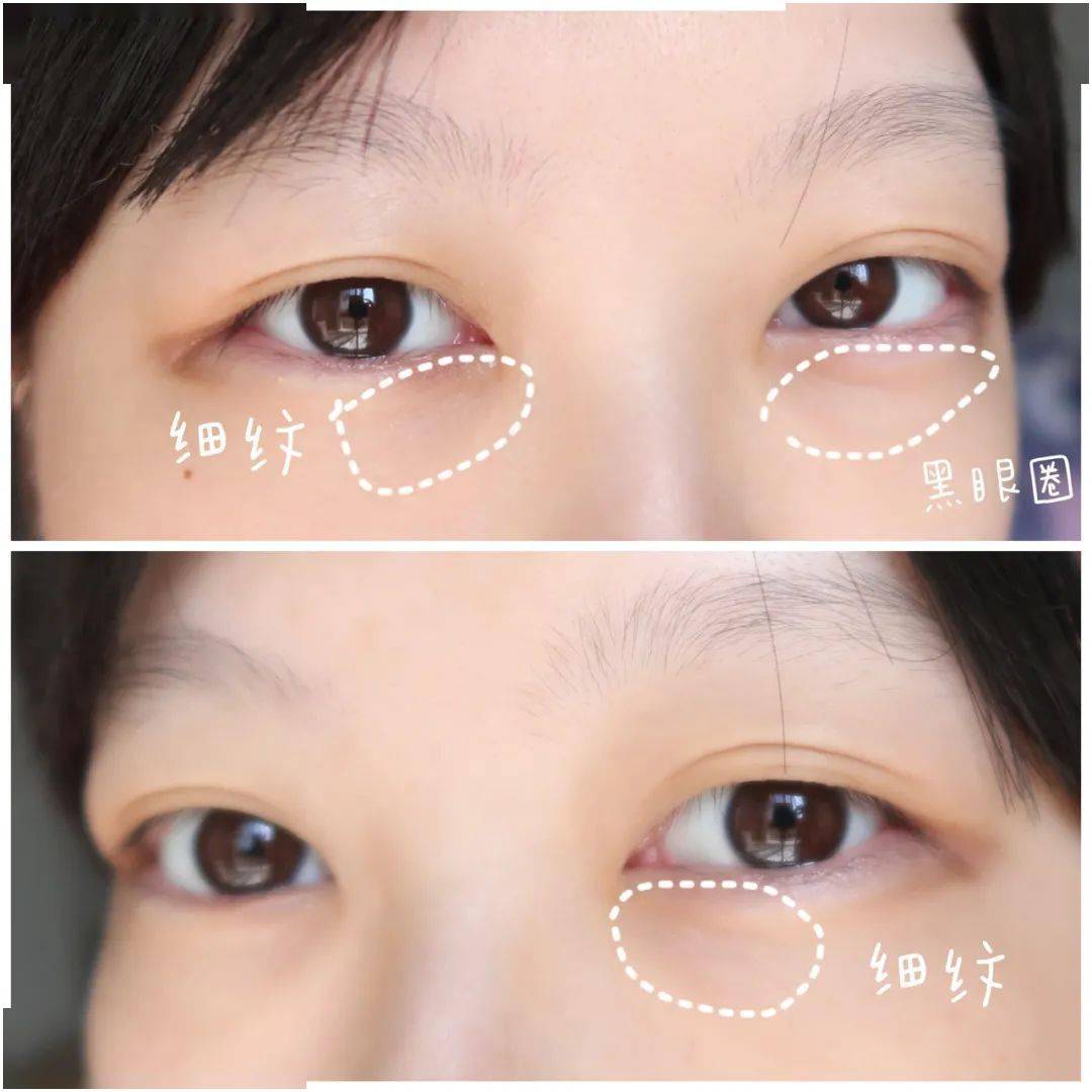 鱼尾纹|黑眼圈、肿眼泡、鱼尾纹，眼睛到底有多暴露年龄？