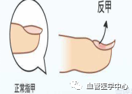 反甲:甲变薄,中央凹陷而四周隆起,呈匙形,主要见于缺铁性贫血者