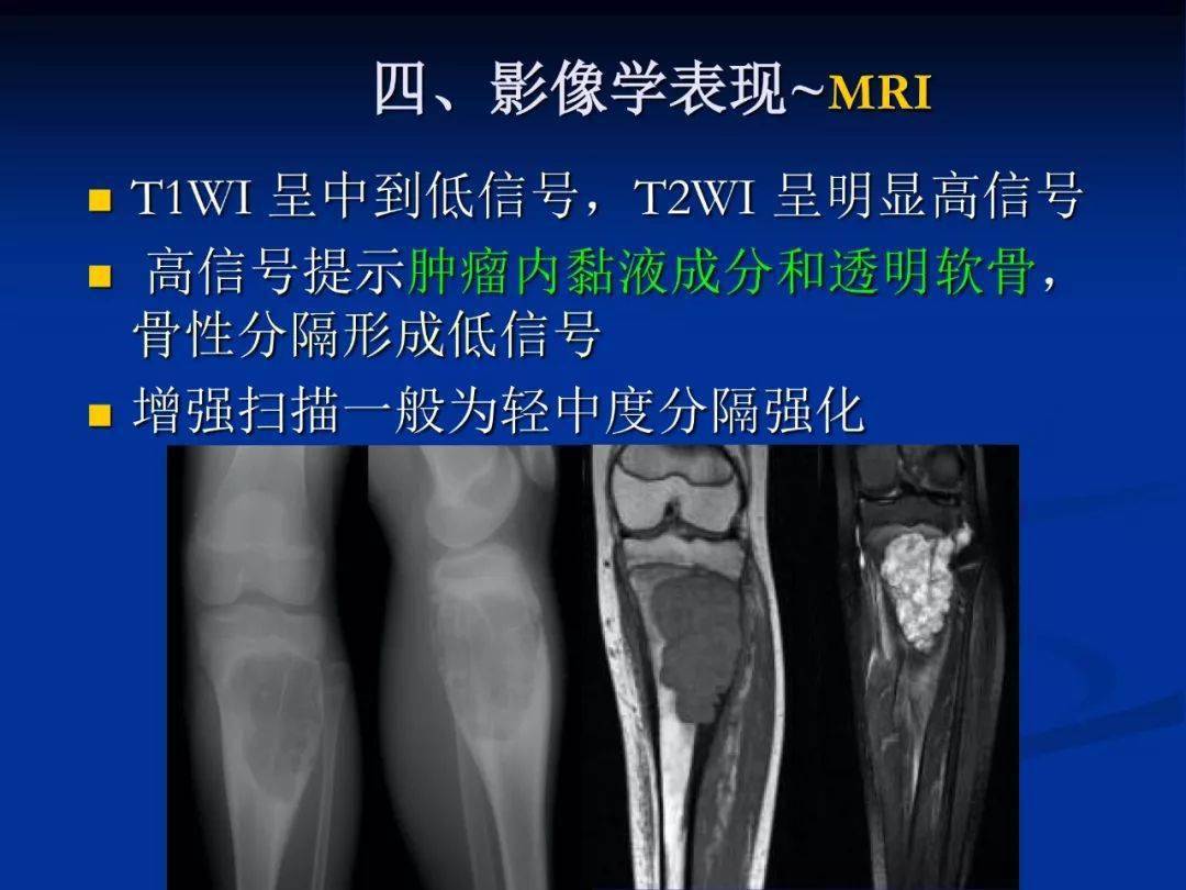 软骨粘液样纤维瘤影像学诊断