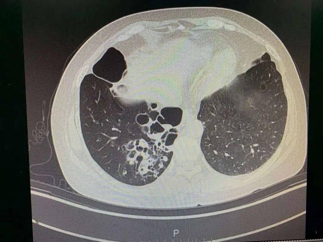 支气管镜:右肺下叶管口见少量白色分泌物,双肺支气管形态正常,粘膜