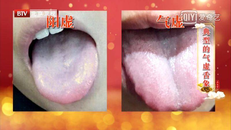 舌头上有裂纹,或是多种疾病征兆……_舌苔
