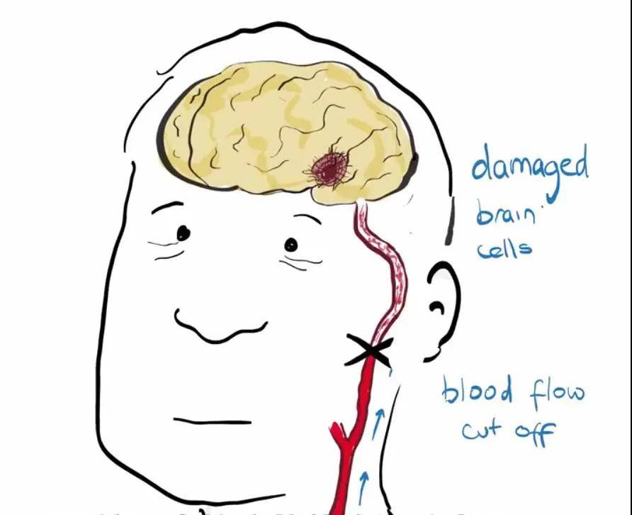 治疗|关于中风，这篇我看懂了！