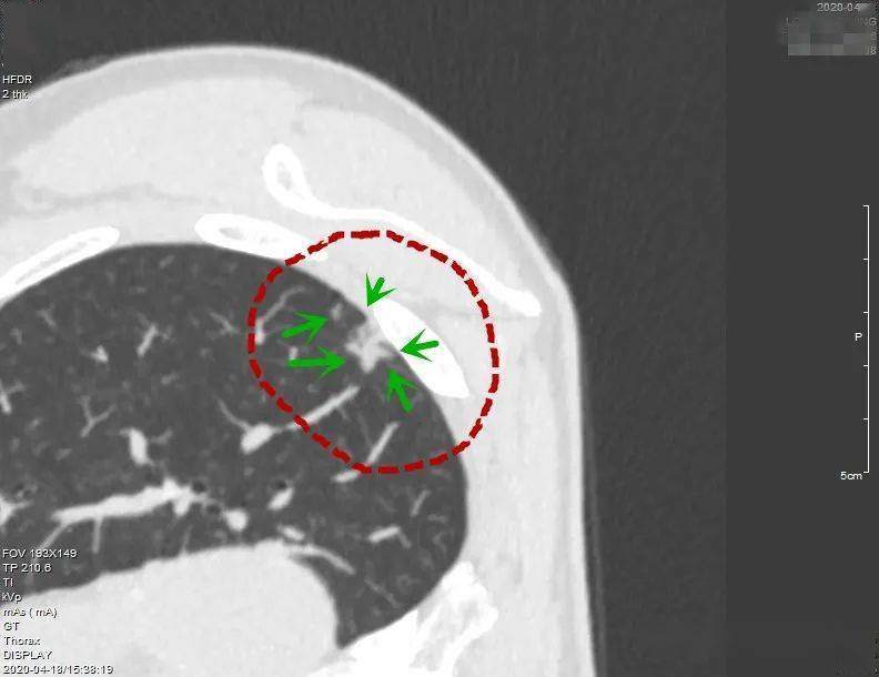 不藏私!只需看这一篇,7年专注肺结节诊治经验之精髓!