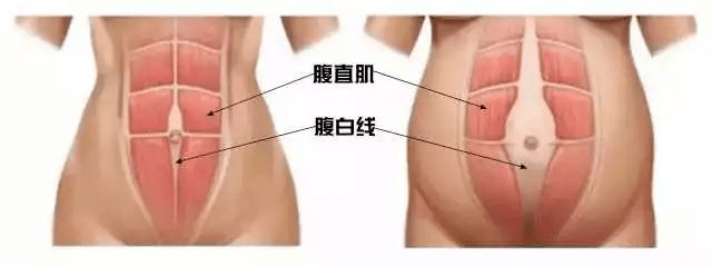 手术|产后两年，肚子仍如怀孕一般，竟是因为......