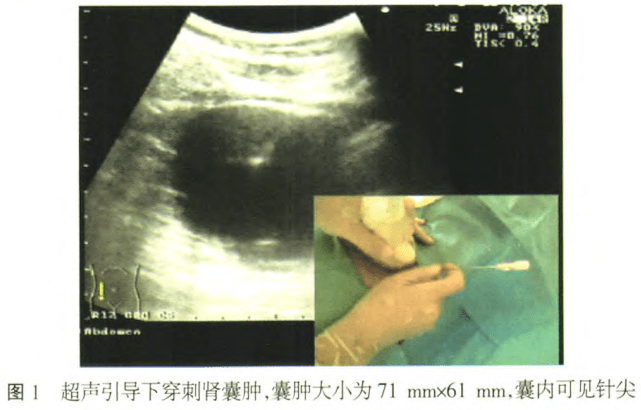 文献推荐 | 超声引导下聚桂醇泡沫硬化疗法治疗单纯性肾囊肿的疗效与