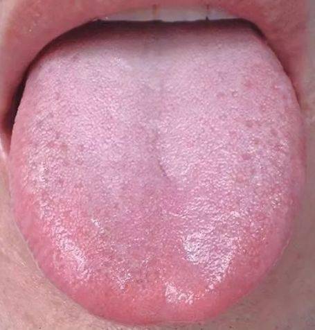 人的舌头可因身体情况而有不同颜色变化,察舌为中医重要的诊断方法