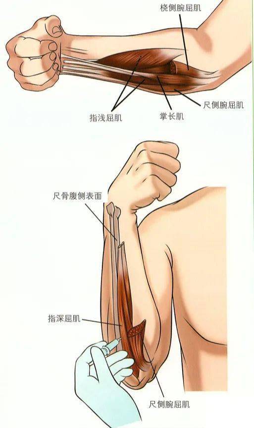 肉毒毒素上肢肌肉注射技巧(上)!