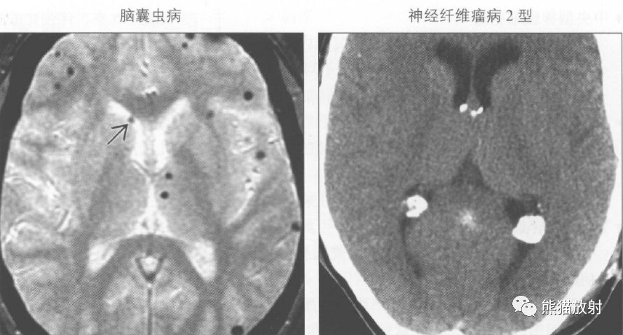 鉴别诊断——脑室内钙化