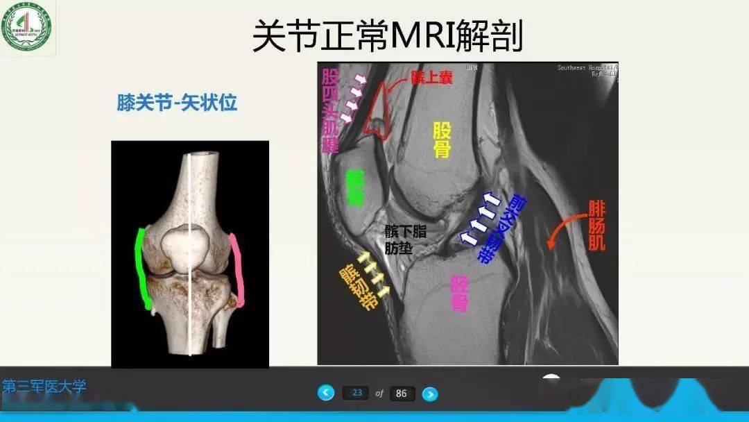 膝关节韧带解剖及mri诊断精确到每个细节