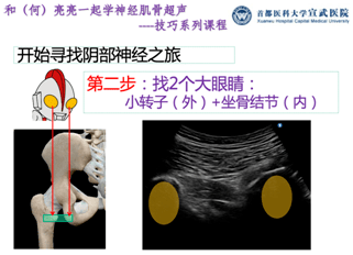 阴部|和（何）亮亮一起学超声技巧系列：超声引导阴部神经阻滞