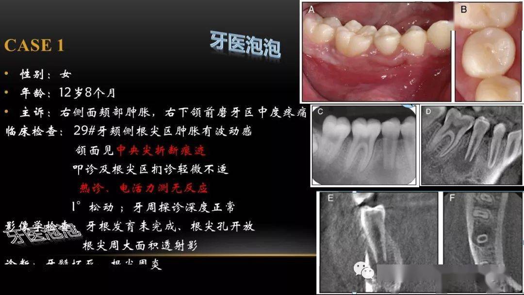 病例分享活髓切断术治疗年轻恒牙根尖周炎的病例报道