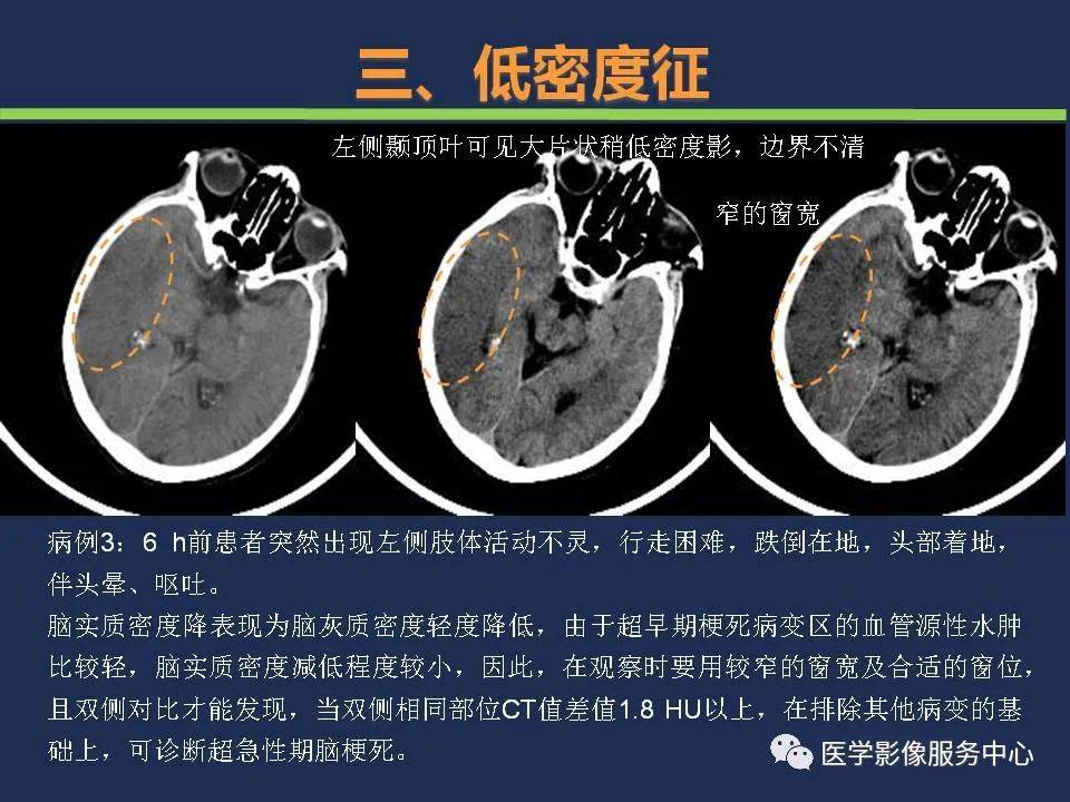 【影像】头颅ct如何预判超早期脑梗死?