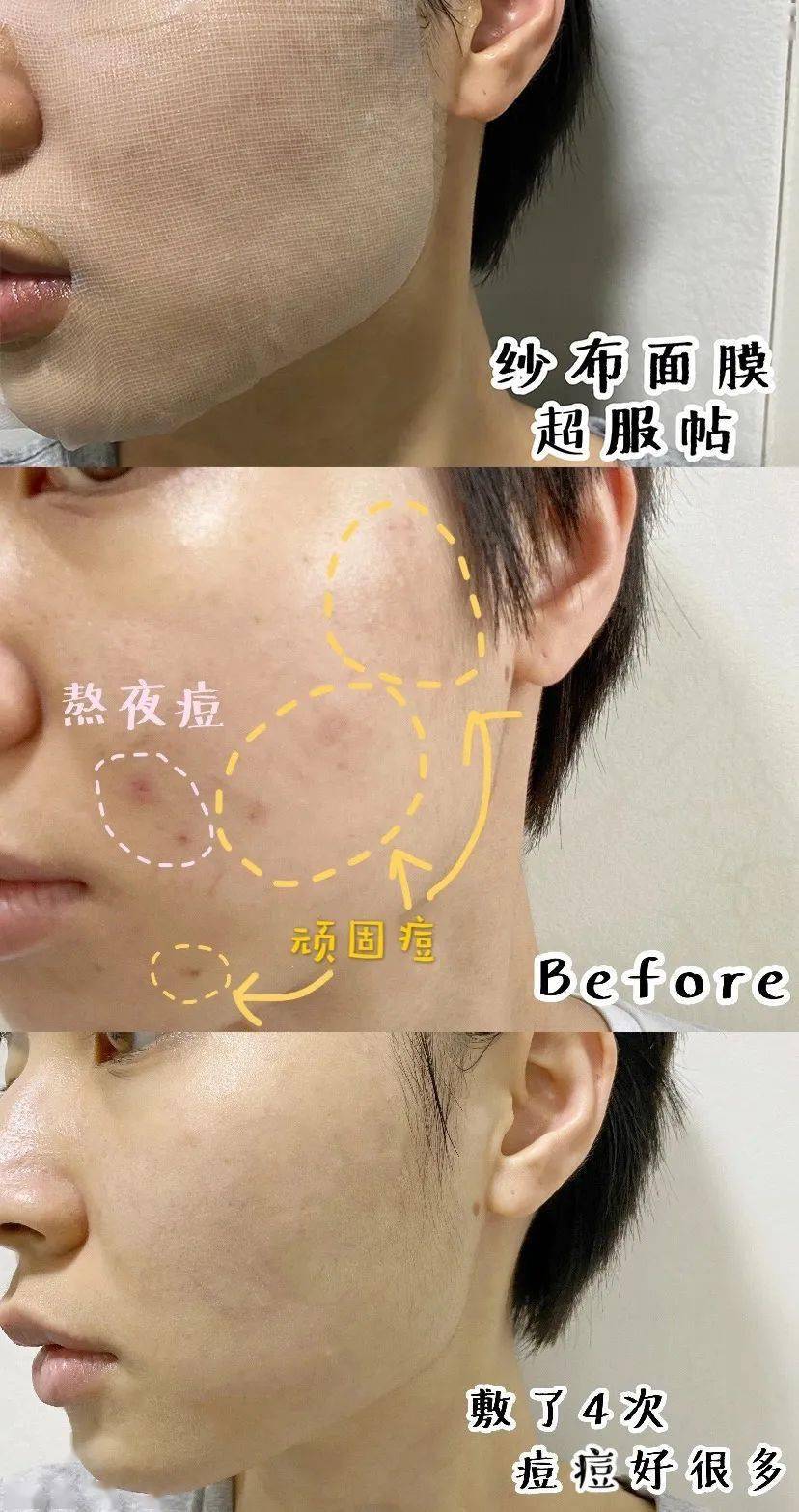 祛痘|长痘几天好不了？学会这招，没有1颗痘活过今晚！