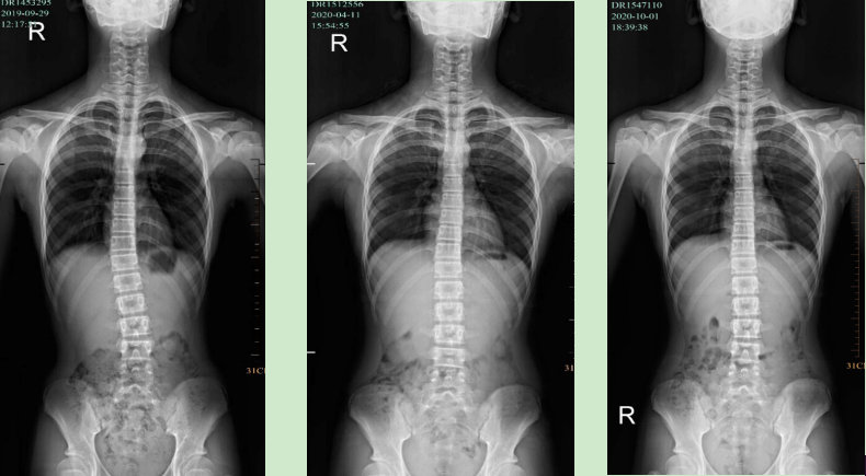 医院接诊了一位14岁女性患者,全脊柱x光片显示轻度脊柱侧