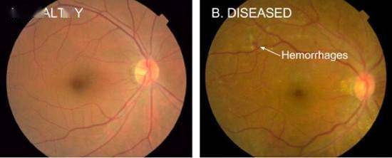 算法|谷歌糖尿病视网膜病变AI检测算法，已在印度和泰国医院应用