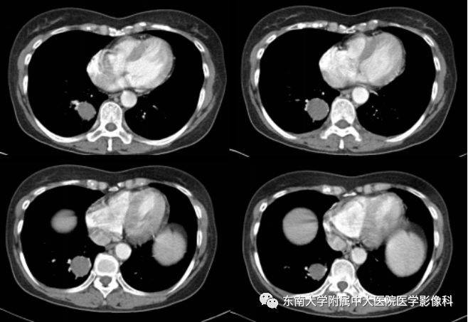 加重两月"入院 ct 平扫  编辑/校对:郑孝飞 病例结果:支气管源性囊肿