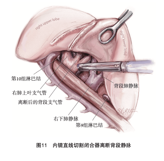 胸腔镜肺叶切除及肺段切除手术图谱｜胸部疾病肺段切除_手机搜狐网